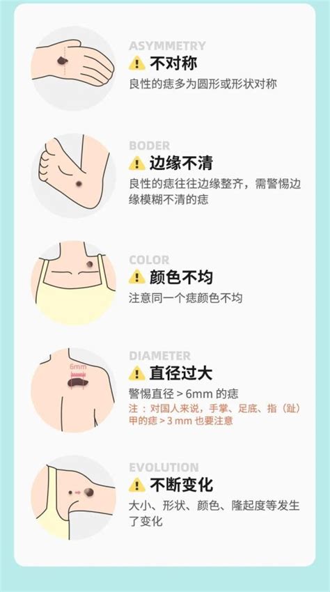 背上很多痣|痣也可能会癌变！长在 3 个地方要注意